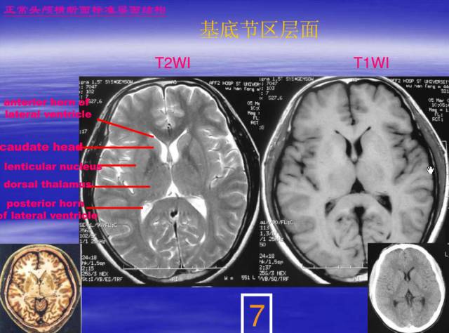 【PPT】中枢神经系统正常影像学表现