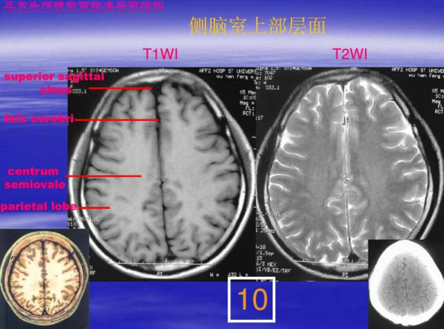 【PPT】中枢神经系统正常影像学表现