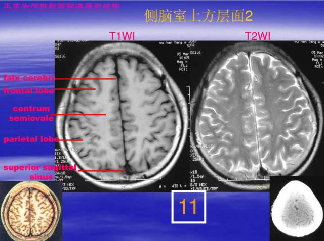 【PPT】中枢神经系统正常影像学表现