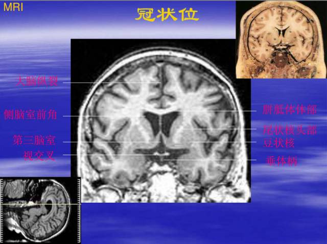 【PPT】中枢神经系统正常影像学表现