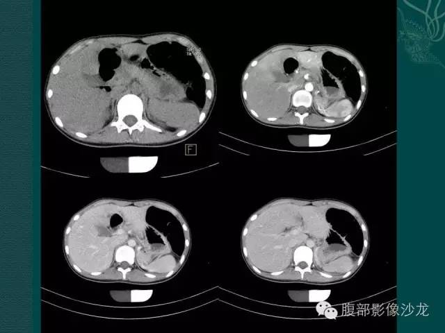 【病例】副脾蒂扭转1例CT影像表现 【病例】副脾蒂扭转1例CT影像表现