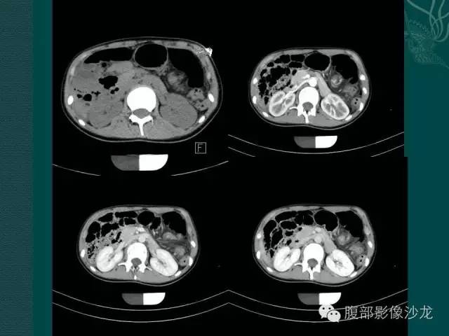 【病例】副脾蒂扭转1例CT影像表现 【病例】副脾蒂扭转1例CT影像表现