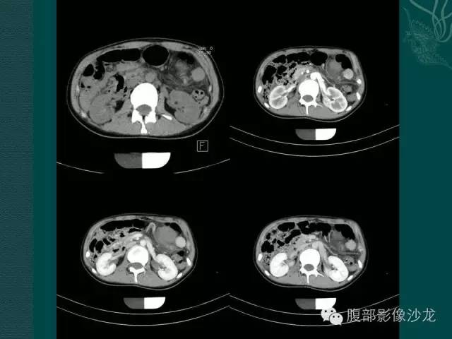 【病例】副脾蒂扭转1例CT影像表现 【病例】副脾蒂扭转1例CT影像表现