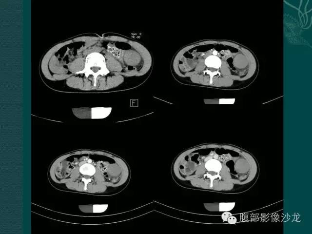 【病例】副脾蒂扭转1例CT影像表现 【病例】副脾蒂扭转1例CT影像表现