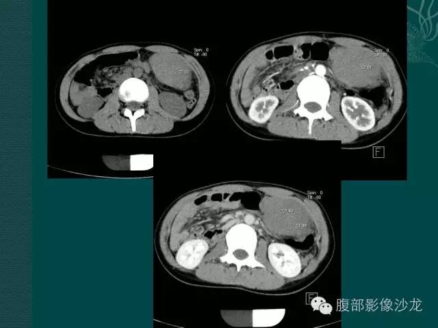 【病例】副脾蒂扭转1例CT影像表现 【病例】副脾蒂扭转1例CT影像表现