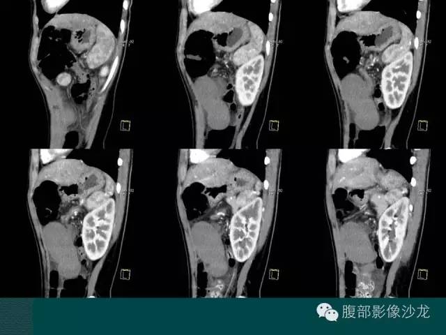【病例】副脾蒂扭转1例CT影像表现 【病例】副脾蒂扭转1例CT影像表现