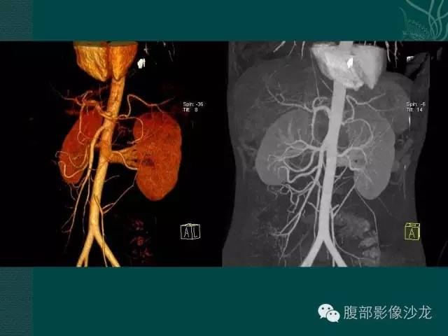 【病例】副脾蒂扭转1例CT影像表现 【病例】副脾蒂扭转1例CT影像表现