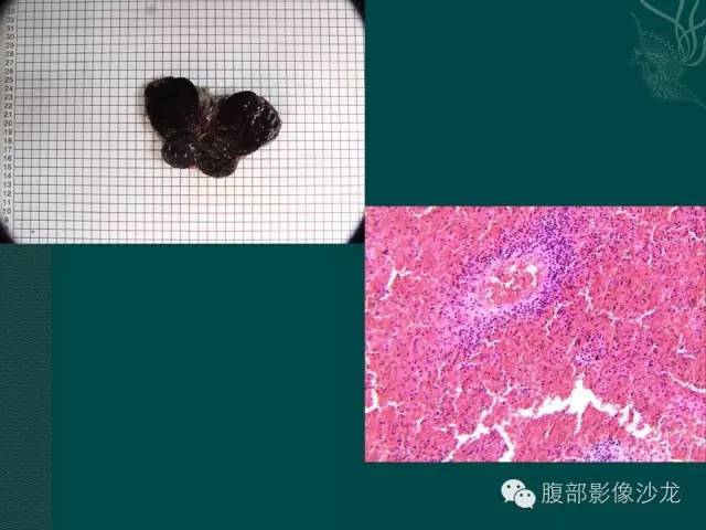 【病例】副脾蒂扭转1例CT影像表现 【病例】副脾蒂扭转1例CT影像表现