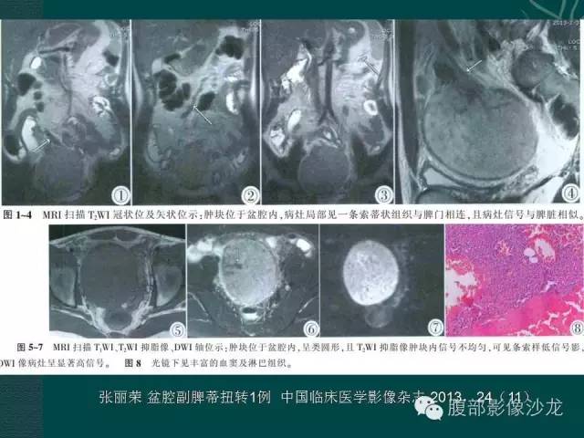 【病例】副脾蒂扭转1例CT影像表现 【病例】副脾蒂扭转1例CT影像表现