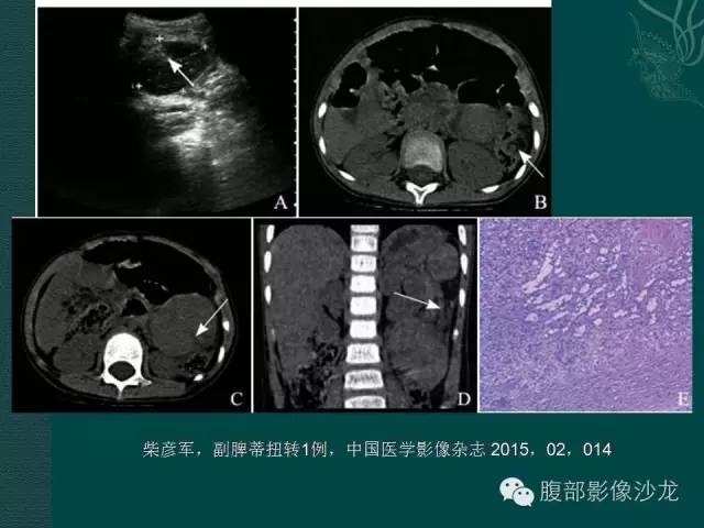 【病例】副脾蒂扭转1例CT影像表现 【病例】副脾蒂扭转1例CT影像表现