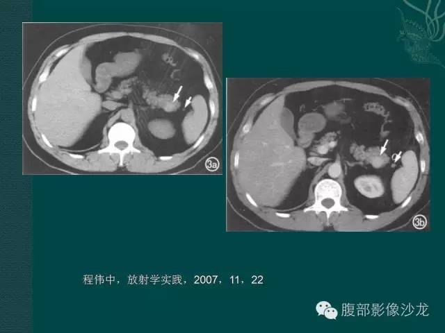【病例】副脾蒂扭转1例CT影像表现 【病例】副脾蒂扭转1例CT影像表现