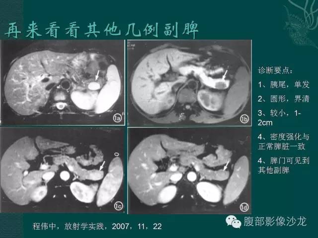 【病例】副脾蒂扭转1例CT影像表现 【病例】副脾蒂扭转1例CT影像表现
