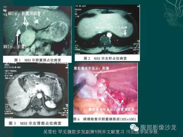 【病例】副脾蒂扭转1例CT影像表现 【病例】副脾蒂扭转1例CT影像表现