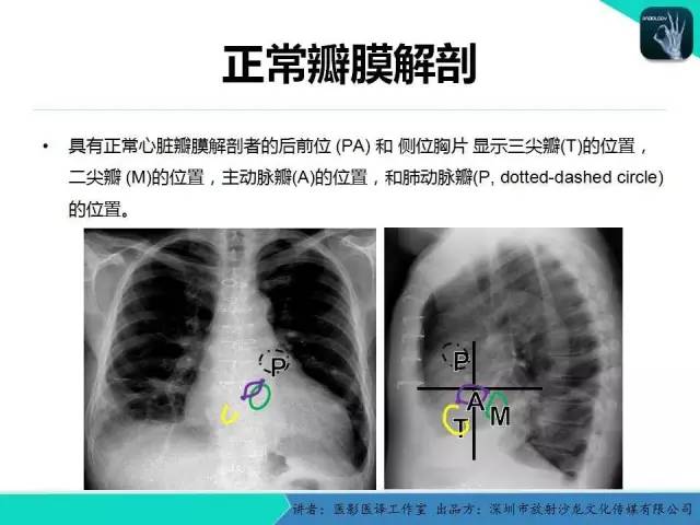 【PPT】普通放射科医生需要了解的成人心脏瓣膜病知识