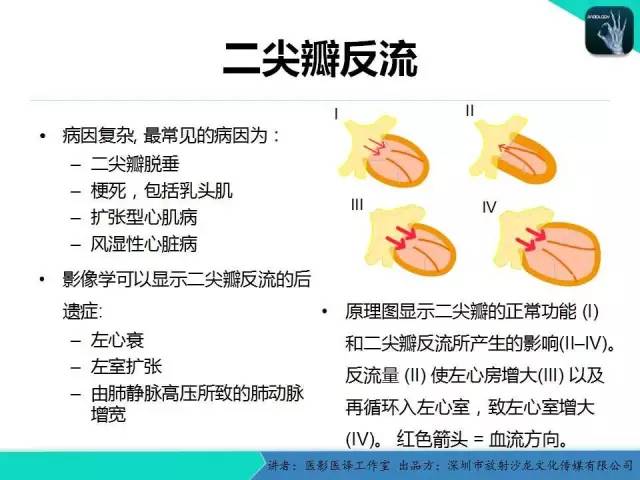 【PPT】普通放射科医生需要了解的成人心脏瓣膜病知识