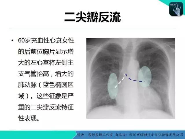 【PPT】普通放射科医生需要了解的成人心脏瓣膜病知识