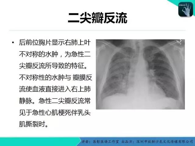 【PPT】普通放射科医生需要了解的成人心脏瓣膜病知识