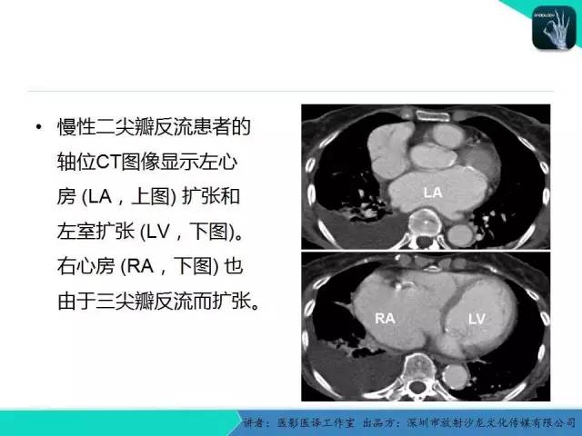 【PPT】普通放射科医生需要了解的成人心脏瓣膜病知识