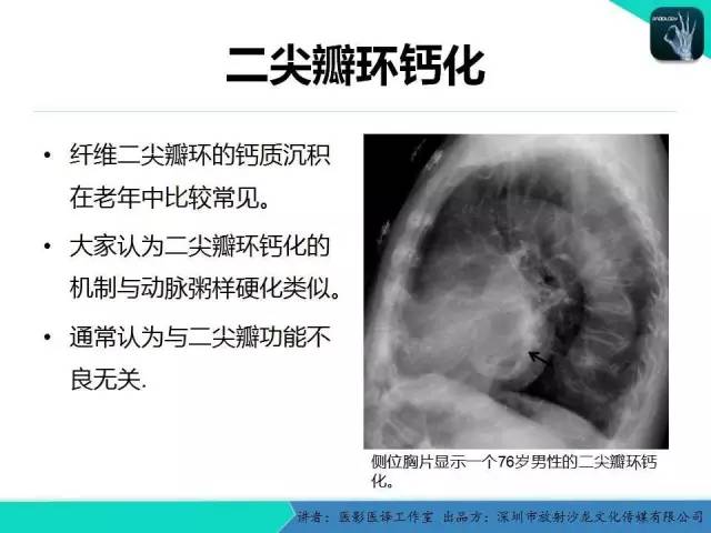 【PPT】普通放射科医生需要了解的成人心脏瓣膜病知识
