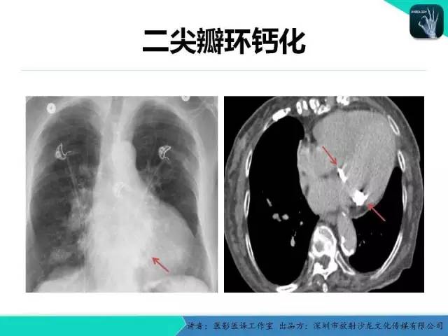 【PPT】普通放射科医生需要了解的成人心脏瓣膜病知识