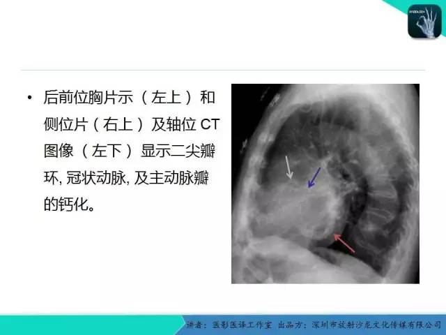 【PPT】普通放射科医生需要了解的成人心脏瓣膜病知识