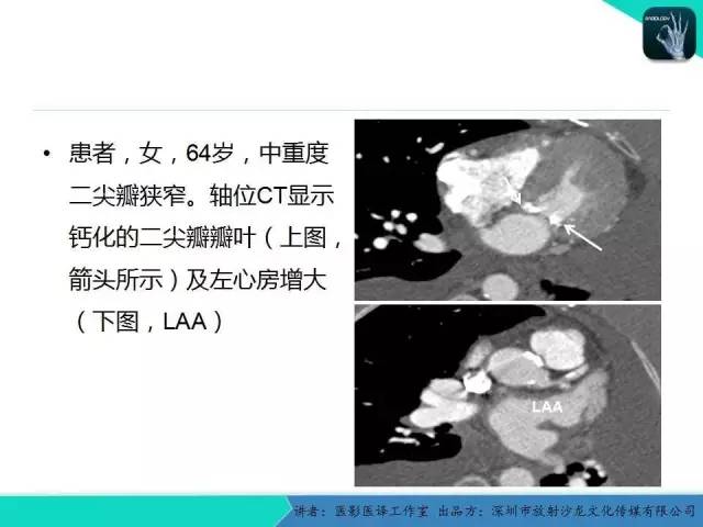 【PPT】普通放射科医生需要了解的成人心脏瓣膜病知识