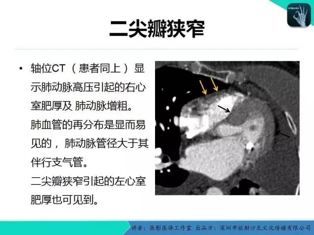 【PPT】普通放射科医生需要了解的成人心脏瓣膜病知识