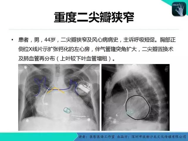 【PPT】普通放射科医生需要了解的成人心脏瓣膜病知识