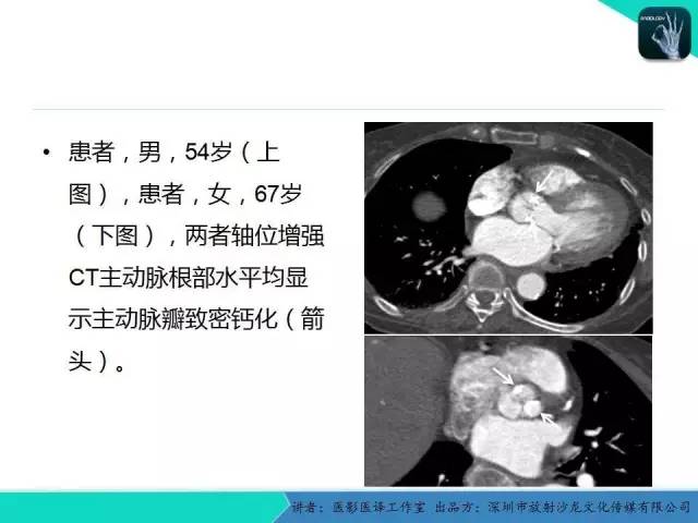 【PPT】普通放射科医生需要了解的成人心脏瓣膜病知识