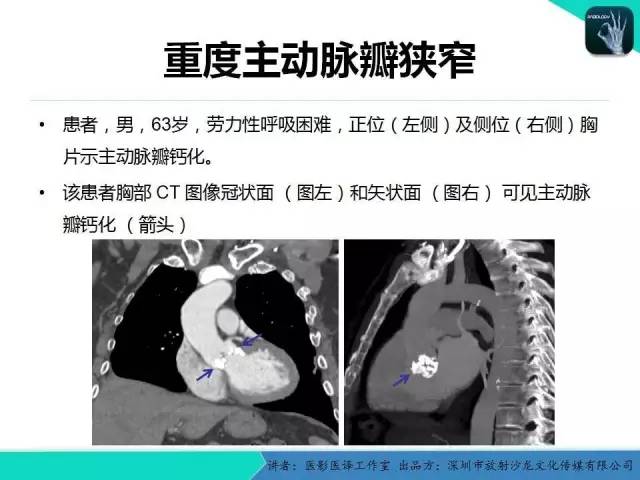 【PPT】普通放射科医生需要了解的成人心脏瓣膜病知识