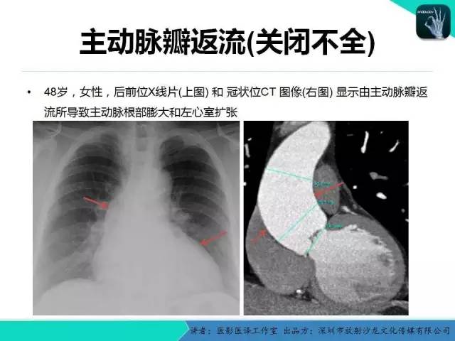 【PPT】普通放射科医生需要了解的成人心脏瓣膜病知识