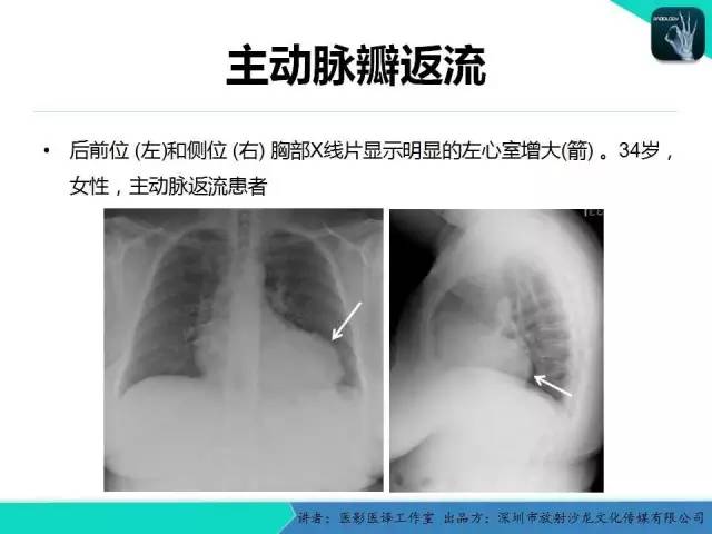 【PPT】普通放射科医生需要了解的成人心脏瓣膜病知识