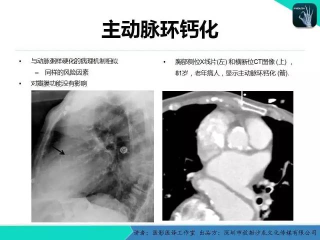 【PPT】普通放射科医生需要了解的成人心脏瓣膜病知识