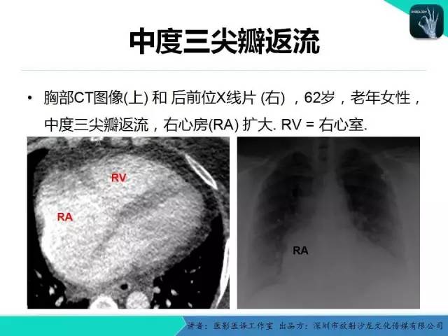 【PPT】普通放射科医生需要了解的成人心脏瓣膜病知识