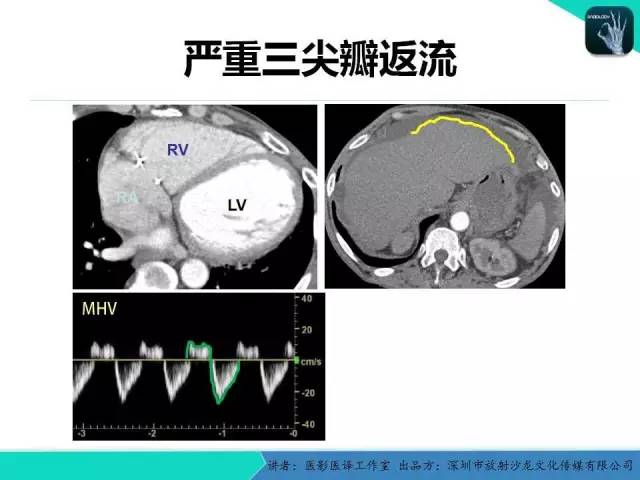 【PPT】普通放射科医生需要了解的成人心脏瓣膜病知识