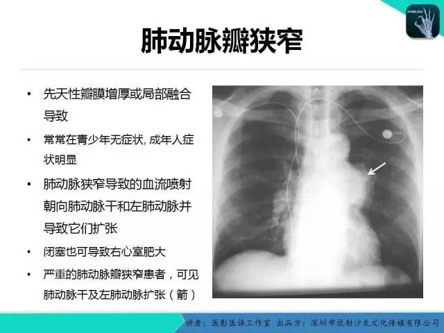 【PPT】普通放射科医生需要了解的成人心脏瓣膜病知识
