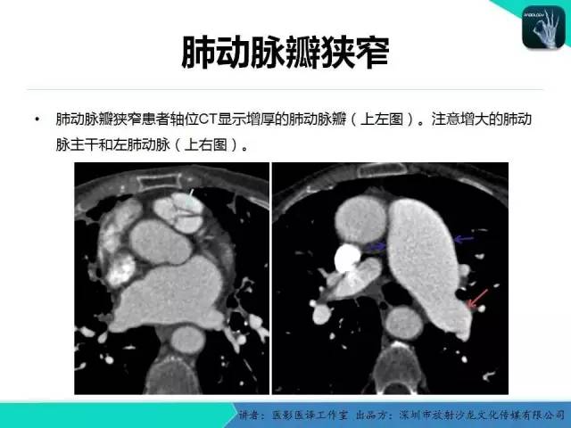 【PPT】普通放射科医生需要了解的成人心脏瓣膜病知识
