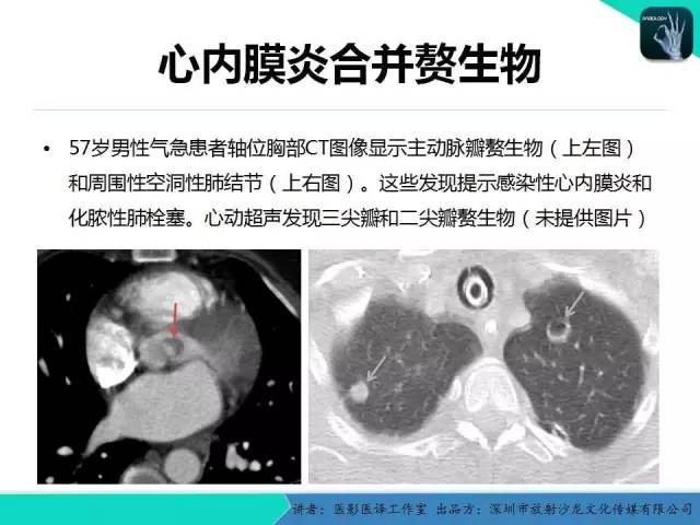 【PPT】普通放射科医生需要了解的成人心脏瓣膜病知识