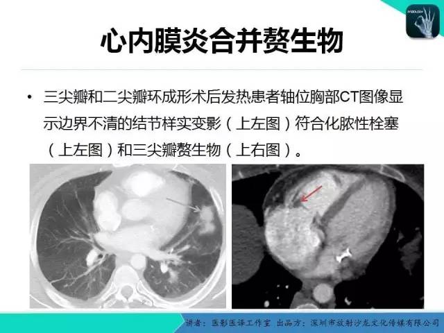 【PPT】普通放射科医生需要了解的成人心脏瓣膜病知识