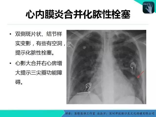 【PPT】普通放射科医生需要了解的成人心脏瓣膜病知识