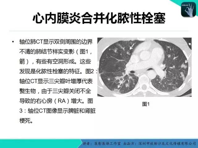 【PPT】普通放射科医生需要了解的成人心脏瓣膜病知识