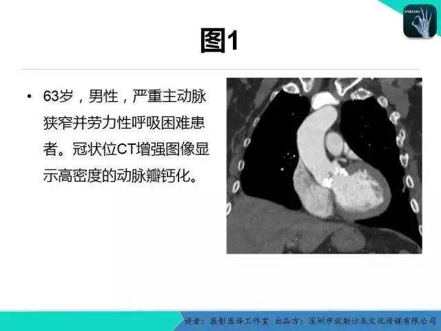 【PPT】普通放射科医生需要了解的成人心脏瓣膜病知识
