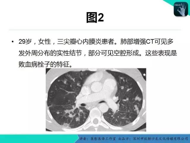 【PPT】普通放射科医生需要了解的成人心脏瓣膜病知识