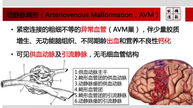 【病例】颅内动静脉畸形1例MR影像表现