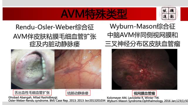 【病例】颅内动静脉畸形1例MR影像表现