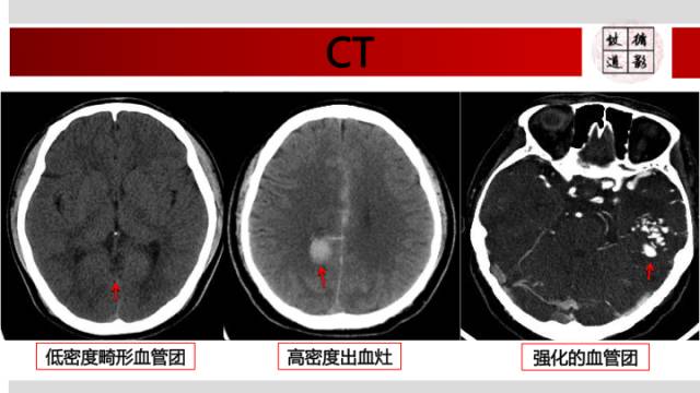 【病例】颅内动静脉畸形1例MR影像表现