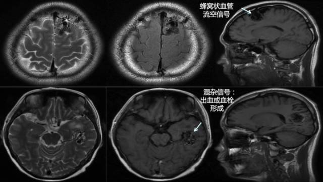 【病例】颅内动静脉畸形1例MR影像表现