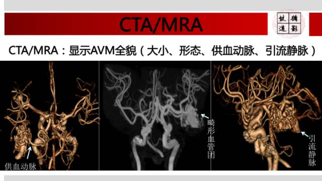 【病例】颅内动静脉畸形1例MR影像表现