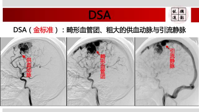 【病例】颅内动静脉畸形1例MR影像表现