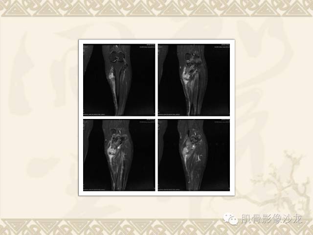 【病例】左胫骨骨肉瘤一例X线MR 【病例】左胫骨骨肉瘤一例X线MR